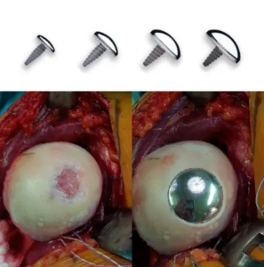 Minimal invasiver implantierbarer Teilgelenkflächersatz (HemiCAP)